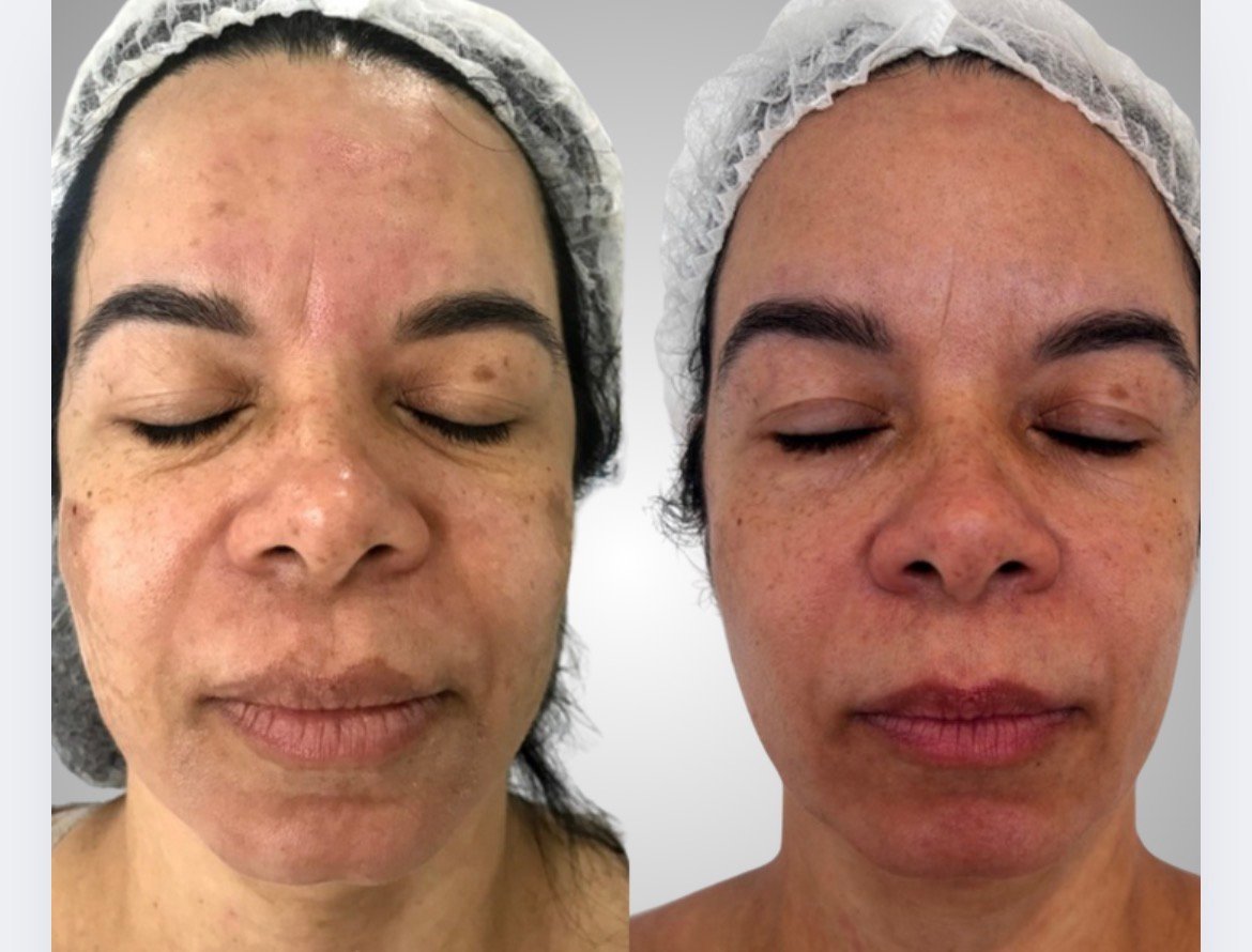 Resultado toxina botulínica